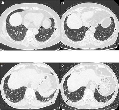 A prospective observational cohort study of the efficacy of tofacitinib plus iguratimod on rheumatoid arthritis with usual interstitial pneumonia